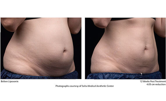 Before and After Liposonix