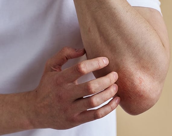 Psoriasis Clinic