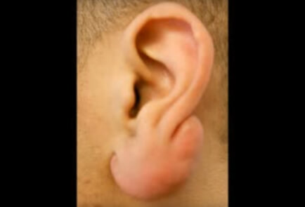 Ear Keloid Treatment