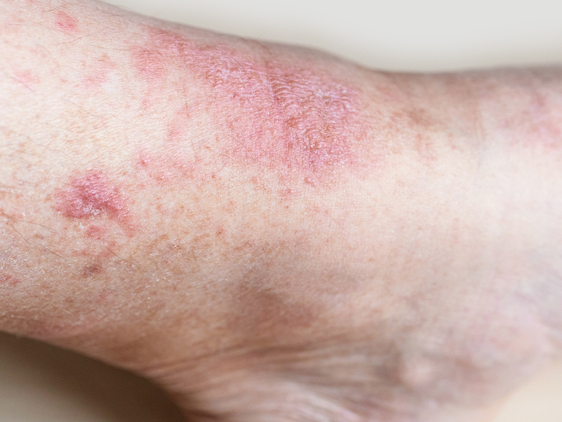 Lichen Planus Treatment