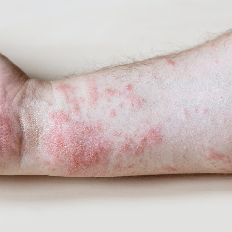 lichen-planus