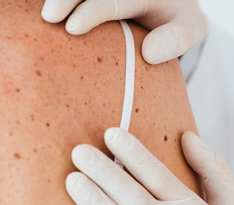 skin mole photography