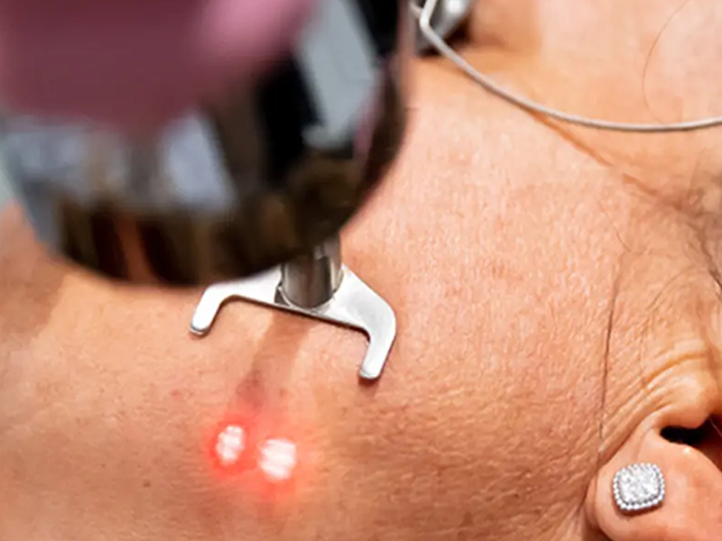 Milia Removal