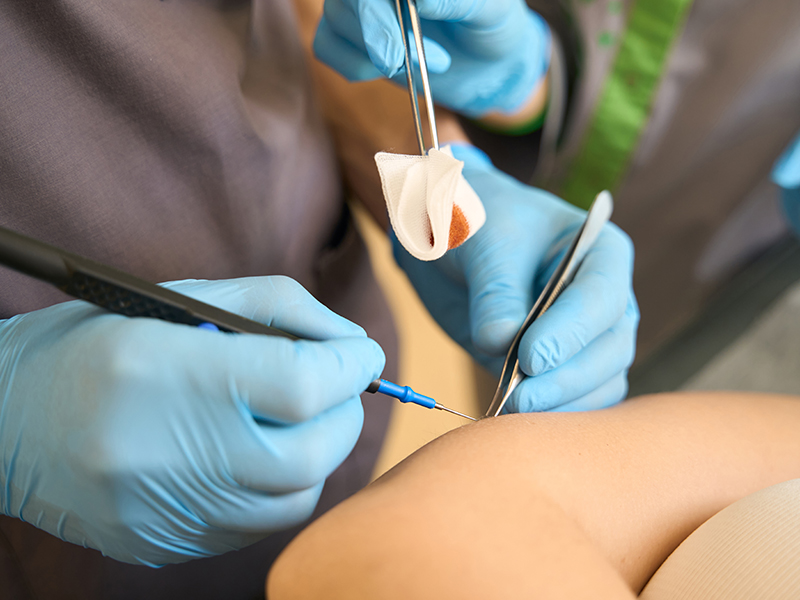 Mohs surgery