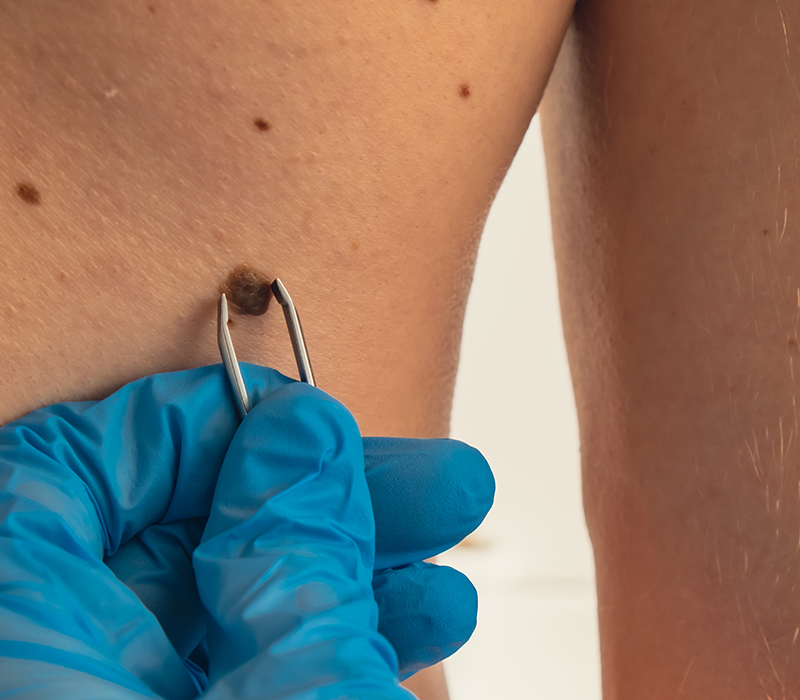 skin tag removal