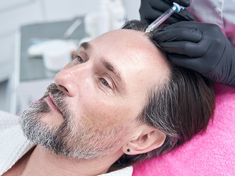 Platelet-Rich Plasma (PRP) for Alopecia Areata