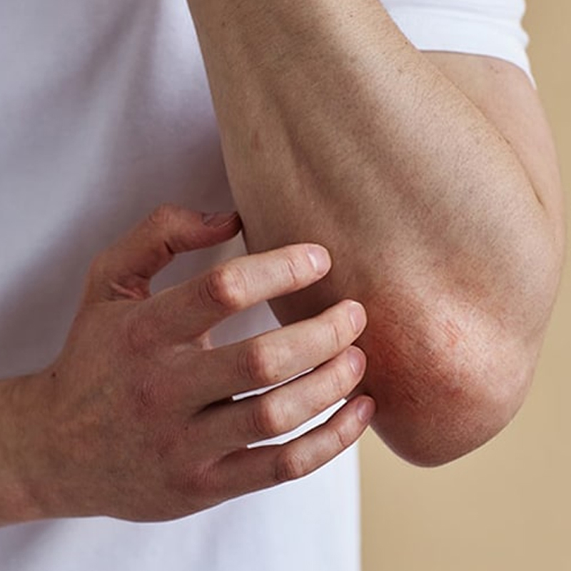 Psoriasis Clinic in London