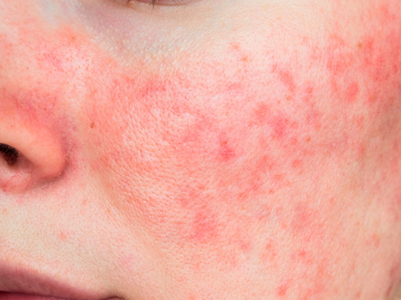 Rosacea Treatment