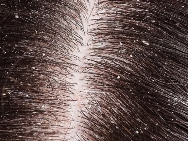 Scalp Dermatologist
