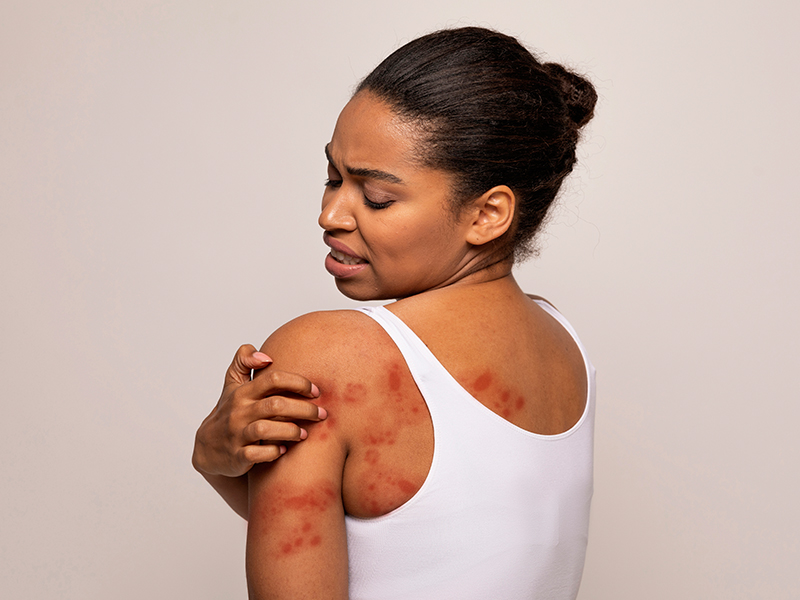Seborrhoeic Dermatitis