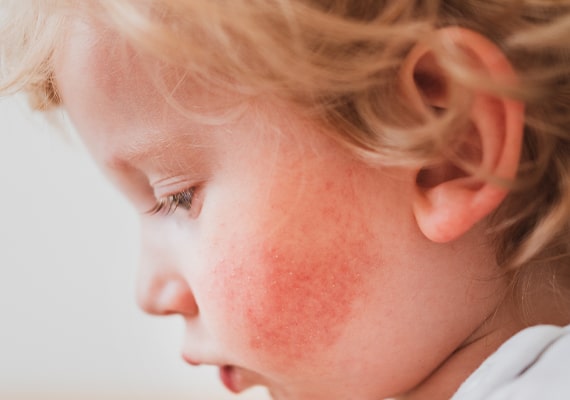 allergy treatment clinic