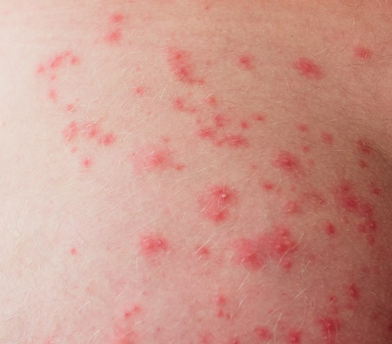allergy consultation