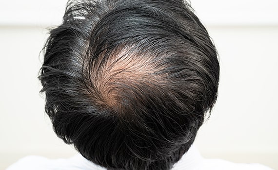 Androgenetic alopecia