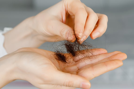 baldness