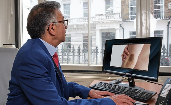 birthmark consultation