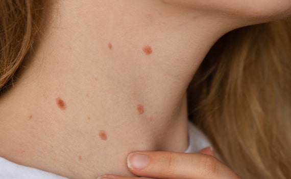 birthmark