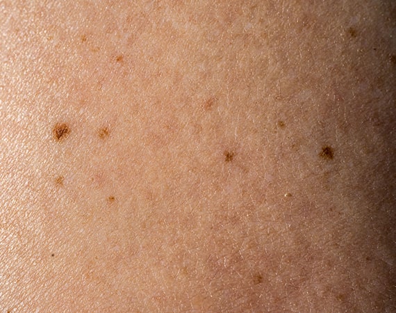 brown spots