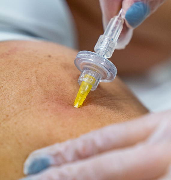 carboxytherapy