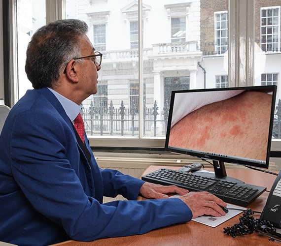 eczema consultation