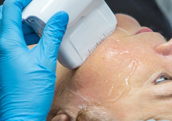 fraxel laser