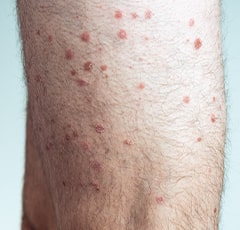 Guttate Psoriasis