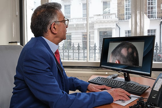 hair loss consultation