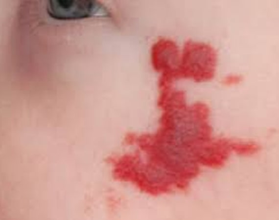 Infantile Haemangiomas
