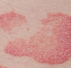 Inverse Psoriasis