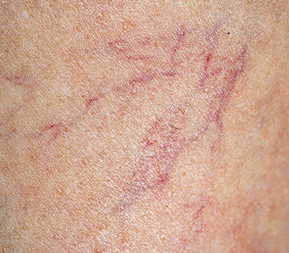 IPL and YAG laser treatment