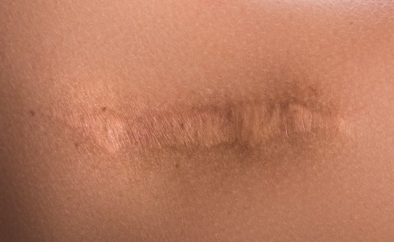 keloid scar