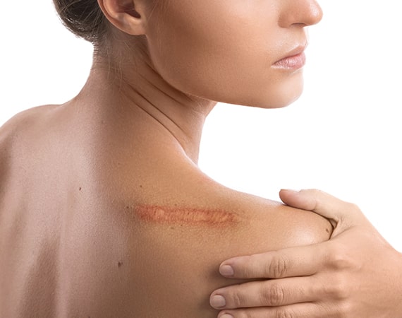 laser treatment