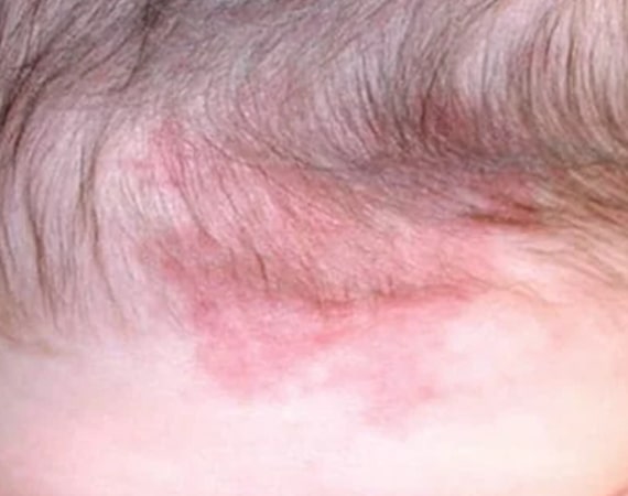 macular stains