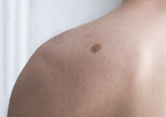 melanoma