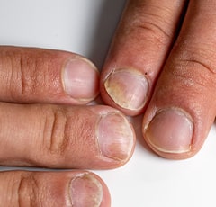 Nail Psoriasis