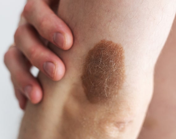 Nevus of Ota