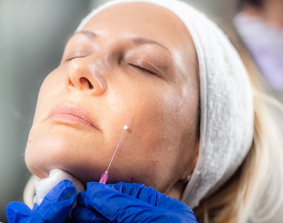 PDO Thread Lift Treatment