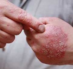 Plaque Psoriasis
