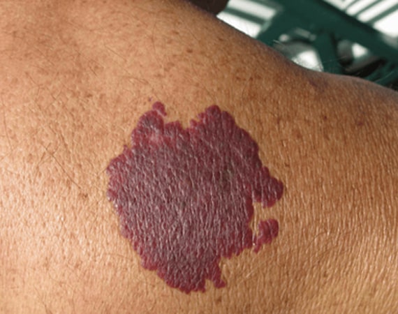 Port Wine Stains 