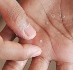 Pustular Psoriasis