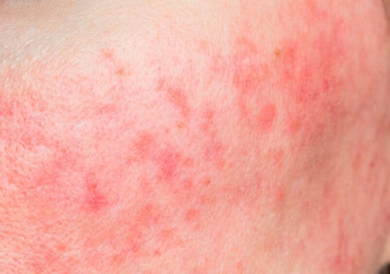 Red Areas