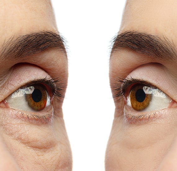 Redensity II Eyes