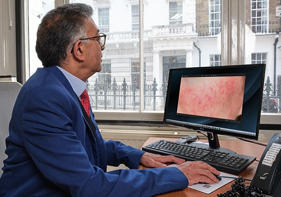 rosacea consultation