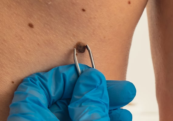 Skin Tag Removal