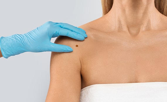 skin tag