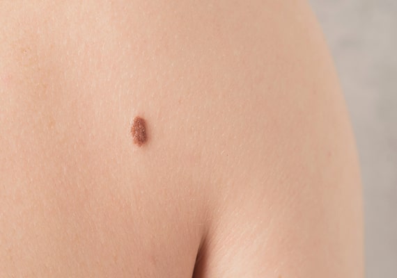 skin tag