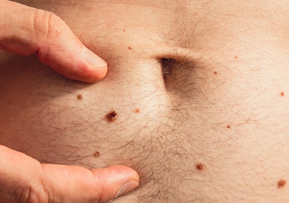 Skin Tag