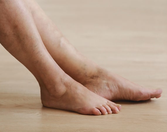 thread vein