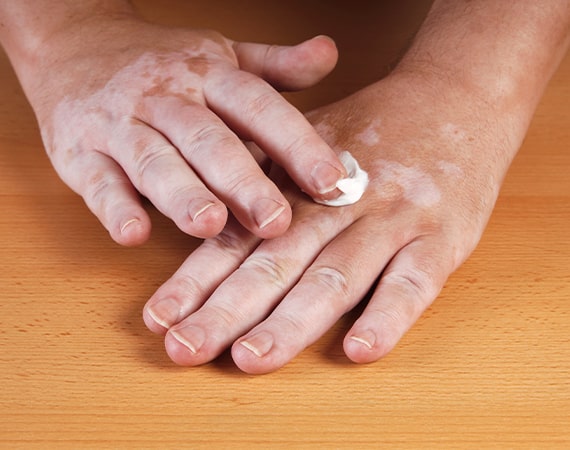 topical treatments