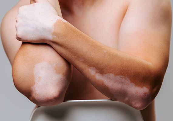 Vitiligo Treatment Clinic