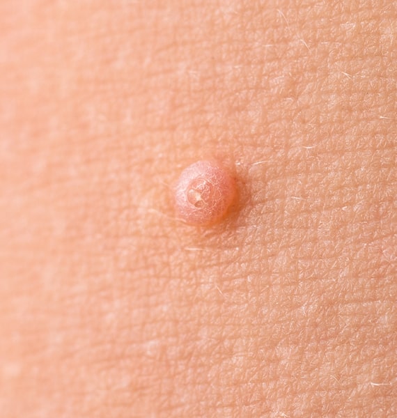 Wart Removal